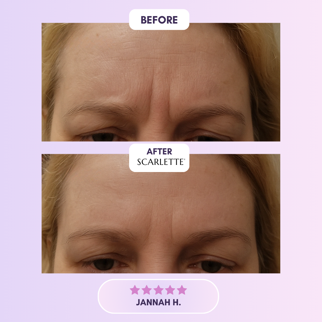 Scarlette™ Collagen Tape