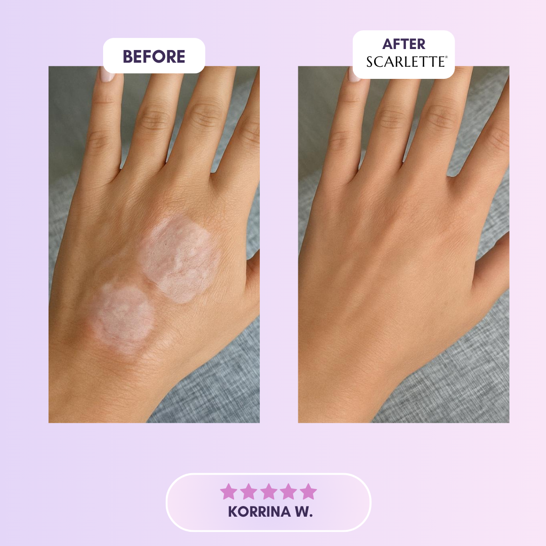 Scarlette™ Collagen Tape