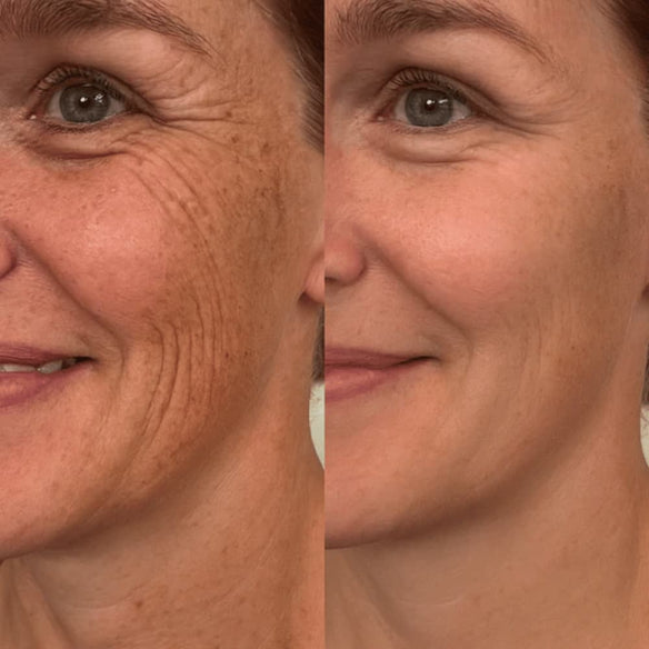 Before and after wrinkles