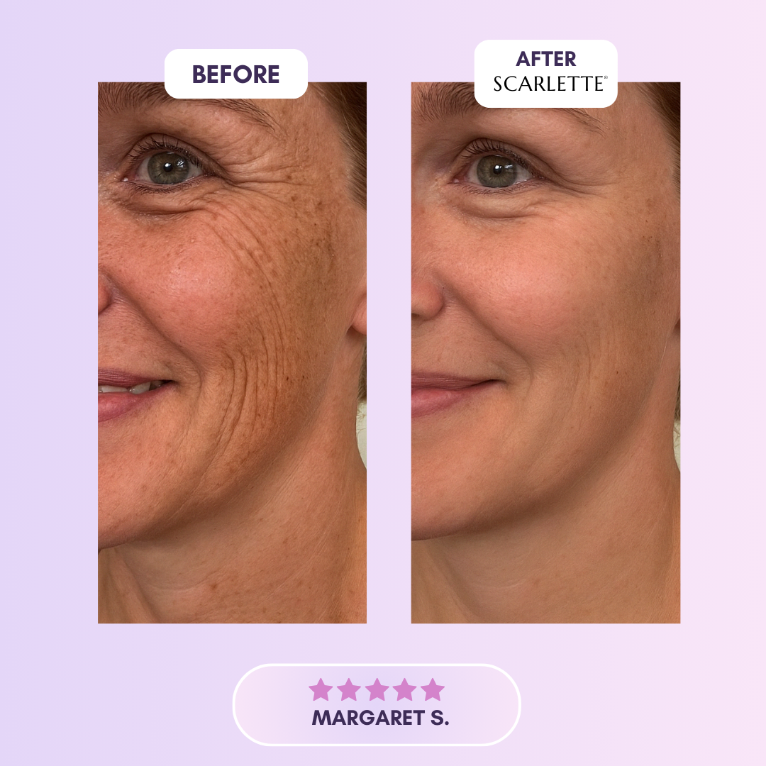 Scarlette™ Silicone Scar Sheet