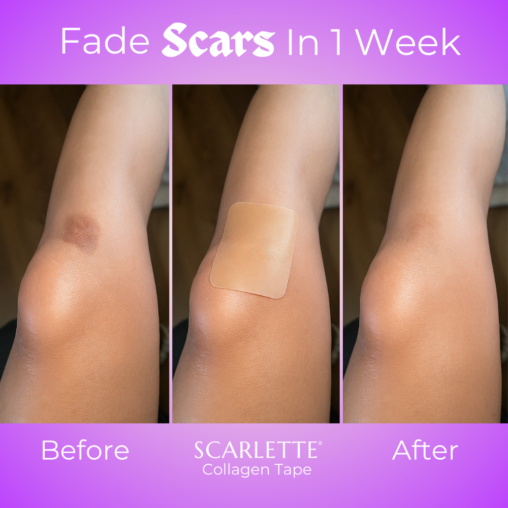 Healed scar before and after comparison