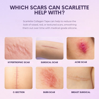 Scarlette™ Silicone Scar Sheet